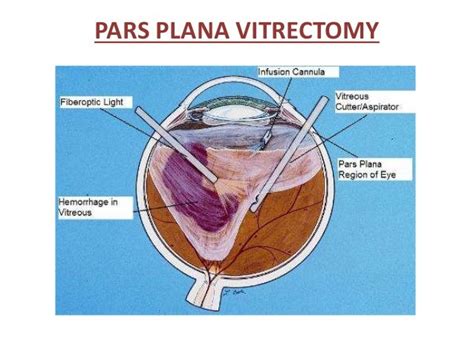 Diabetic retinopathy