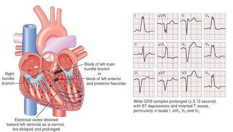 Left bundle branch block | Cardiac nursing, Paramedic, Acls