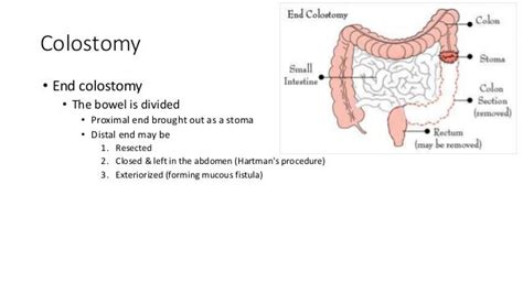 Ileostomy And Mucous Fistula