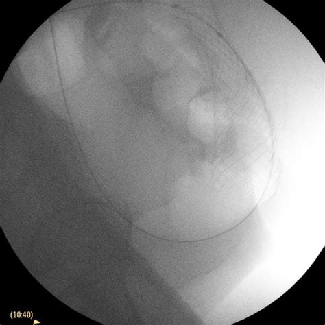 Post procedure X-ray colonic stent (sigmoid colon). | Download Scientific Diagram