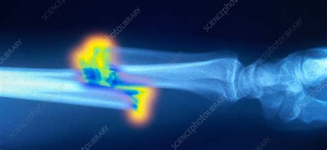 Broken Arm, X-ray - Stock Image - C017/4389 - Science Photo Library