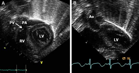 Echo frames from subcostal long-axis views of the ventricles... | Download Scientific Diagram