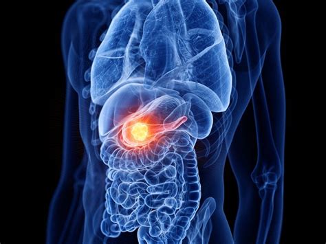 Necrotizing Pancreatitis: Symptoms, Causes, Treatment