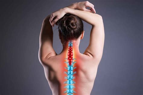 Prolapsed or Herniated Disc in the Neck | Blackberry Clinic Blog