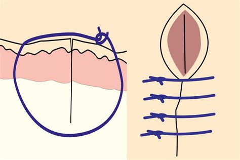 Common Suture Patterns and Suture Techniques - EndoGynecology