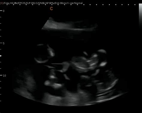 Quadruplets Ultrasound