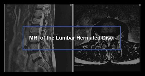 MRI of the Lumbar Herniated Disc - Dr. Kevin Pauza, The Discseel® Procedure inventor