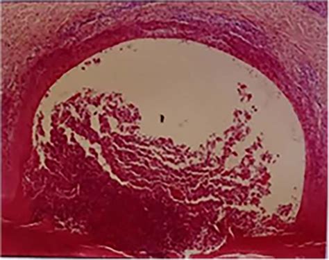 Frontiers | Percutaneous vertebroplasty for SAPHO syndrome with vertebral destruction: a case ...