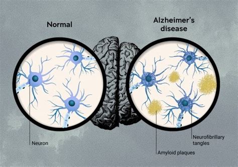 Clinical trial results for lecanemab are a significant step for Alzheimer's, but not a historic ...