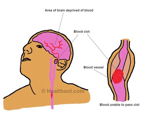 Blood Clots in the Brain - Symptoms, Causes, Treatment