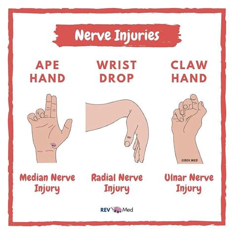 Doctor Medicine on Instagram: “ ️Median Nerve “Ape Hand”⁣⁣ ⁣⁣ Compression of the median nerve ...