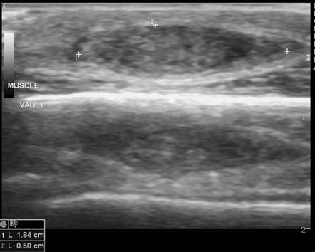 Skin Hemangioma Ultrasound