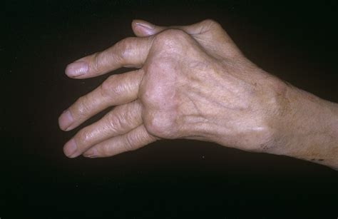 Polyarthritis: Symptoms, Causes, Diagnosis, and Treatment