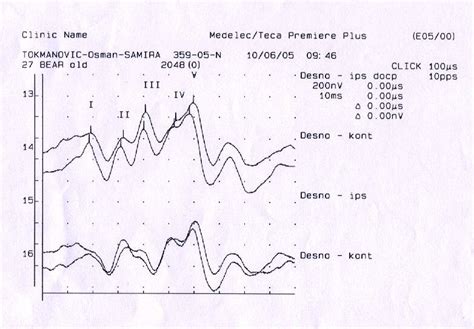 Normal auditory evoked potentials | Download Scientific Diagram