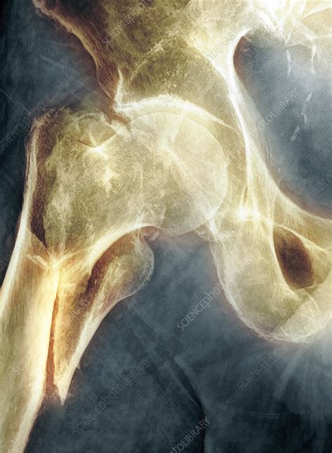 Broken hip, X-ray - Stock Image - C050/9713 - Science Photo Library