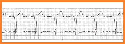 Float Nurse: Basic EKG Rhythm Test 18