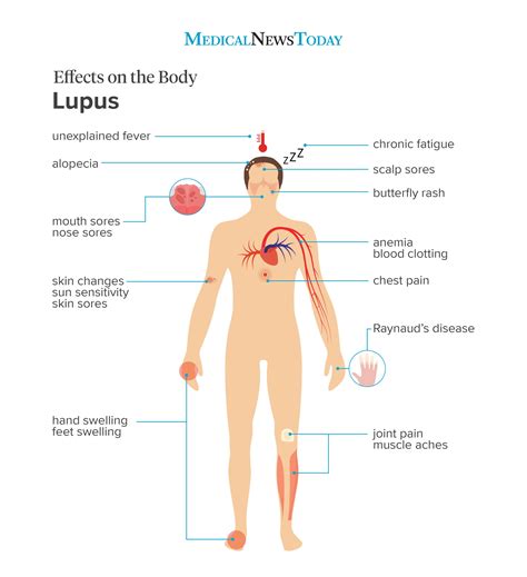 Early signs of lupus: How to identify them