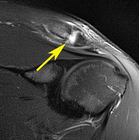 Mahmdullah / Shoulder Ligament Tear - IDOR 2019 - Sports Imaging