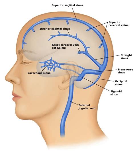 dural venous sinuses | Cerebral (brain) venous thrombosis is uncommon ...