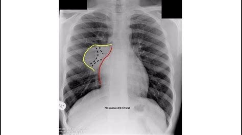 Hilum overlay sign on Chest X-ray to localise lesion in mediastinum - YouTube