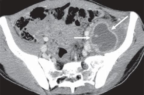 Iliopsoas muscle abscess. CT shows voluminous fluid collection with... | Download Scientific Diagram