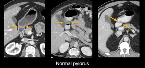 Abdominal CT: oesophagus and stomach • LITFL • Radiology