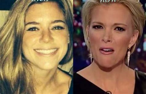 Megyn Kelly Nose Job Before And After