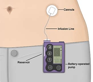 Insulin Pump Therapy: How It Works and Its Advantages - HealthXchange