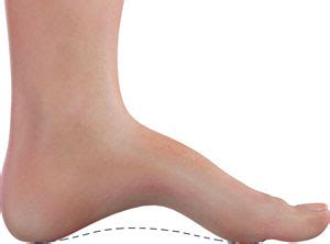 Cavus Foot (high arches): causes, symptoms and treatments