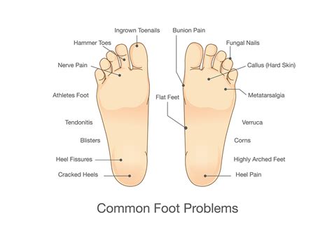 Common Foot Problems | Werkman, Boven & Associates