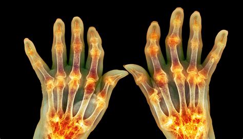 These cells spike before rheumatoid arthritis flare-ups - Futurity