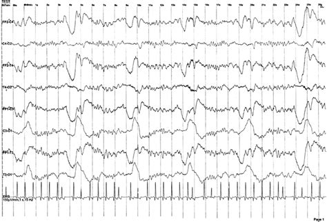 Anoxic Myoclonic Status Epilepticus | Neupsy Key