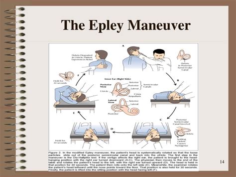 Printable Epley Maneuver Patient Handout