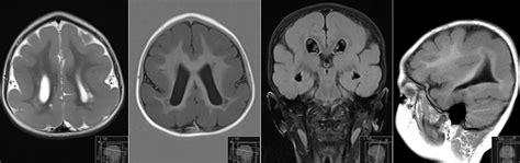 Lissencephaly - Radiology Imaging