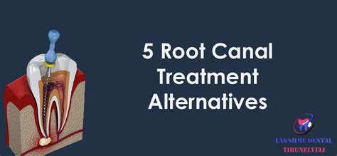 5 Root Canal Treatment Alternatives