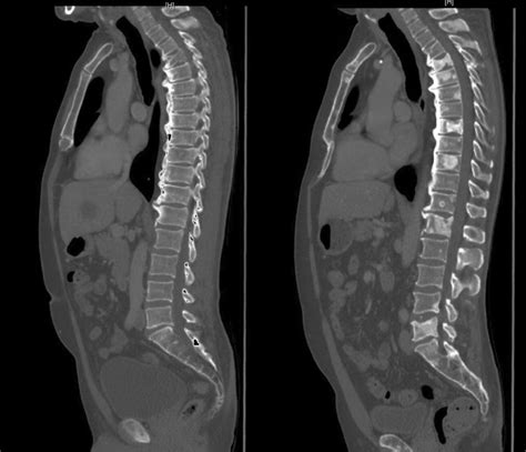 Sclerotic changes within bone metastases as response to treatment. The... | Download Scientific ...