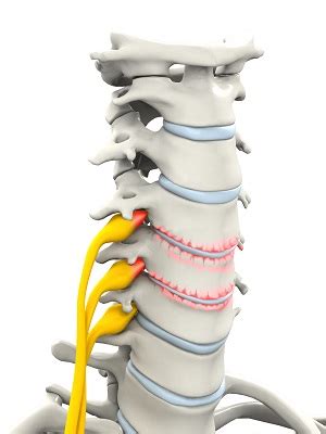 Cervical Arthroplasty | Advanced Orthopaedics & Sports Medicine ...