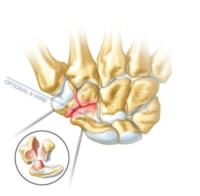 STT Fusion - Dr Rekant - TriMed Inc.