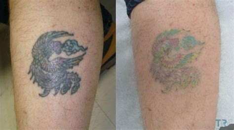 Tattoo removal cream before and after | Up Forever