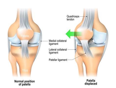 Patellar Dislocation Injury | Kneecap Instability | Orthopedic Knee ...