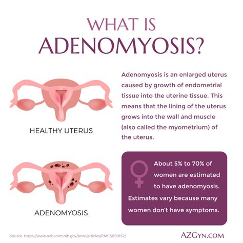 Adenomyosis Risk Factors | Adenomyosis Causes and Symptoms