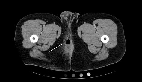 Perianal Abscess - JETem