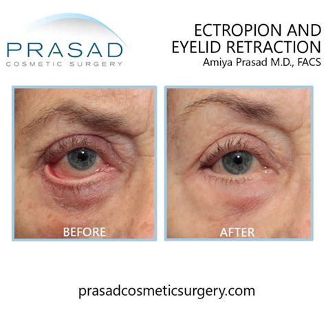 Can Eye Bag Surgery Go Wrong? | Dr. Prasad Blog