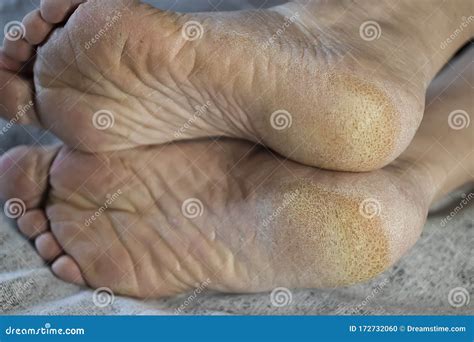 Feet of a Patient with Diabetes. Diabetic Foot. Hyperkeratosis and Cracks in the Skin of the ...