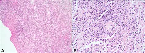 Histology from the genital ulcer in case 1. (A) Extensive mixed ...