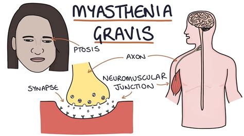 Myasthenia Gravis - 03 Symptoms, Causes & Complications