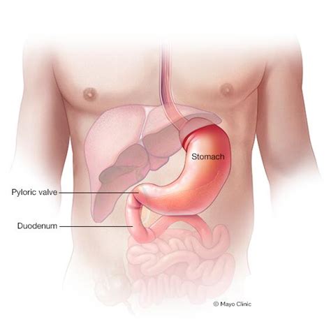 Stomach polyps - Symptoms & causes - Mayo Clinic