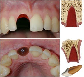 Tooth Avulsion; Dislocation, Tooth; Tooth Luxation; Avulsed Tooth