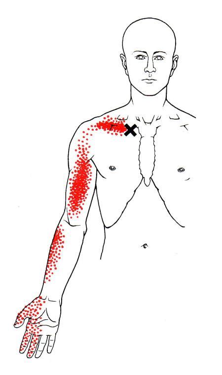 Subclavius | The Trigger Point & Referred Pain Guide