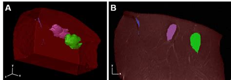 18. MRI reconstruction of hydrogel injection. (A) 3D reconstruction of... | Download Scientific ...